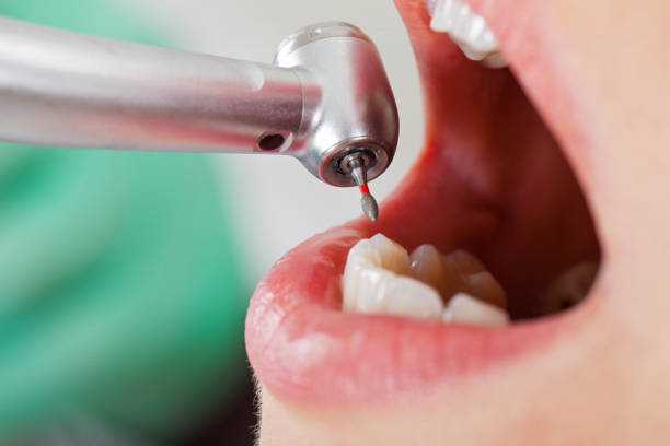Best Emergency Treatment for Dental Infections or Abscesses in Nevada, TX